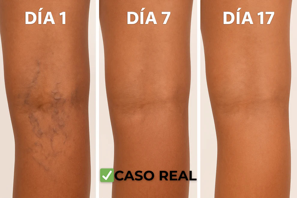 🌸Parches Naturales para las Varices y para las Piernas Cansadas - VeinPatch™ ®