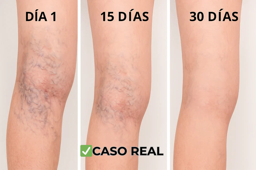 🌸Parches Naturales para las Varices y para las Piernas Cansadas - VeinPatch™  ®